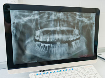 Computerbildschirm mit digitaler Röntgenaufnahme davor Computertastatur